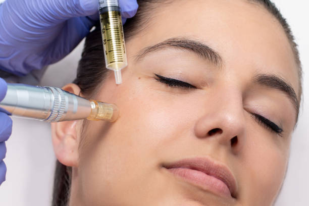 Dermapen Collagen induction theraphy