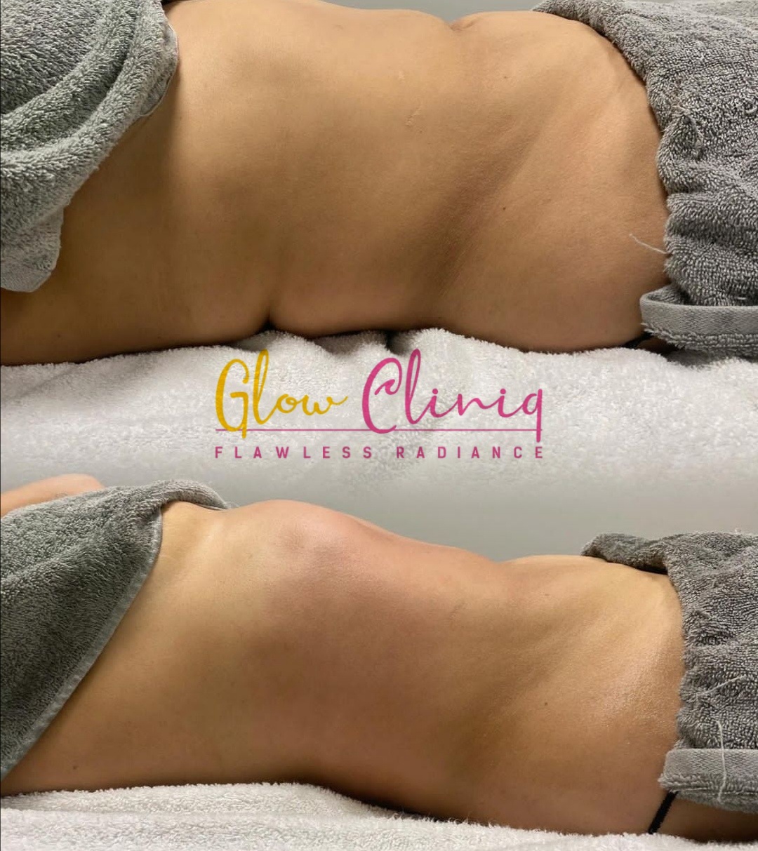 Before and after pictures (fat reduction)