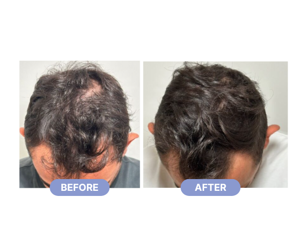 Hair Regenera Activa Treatment
