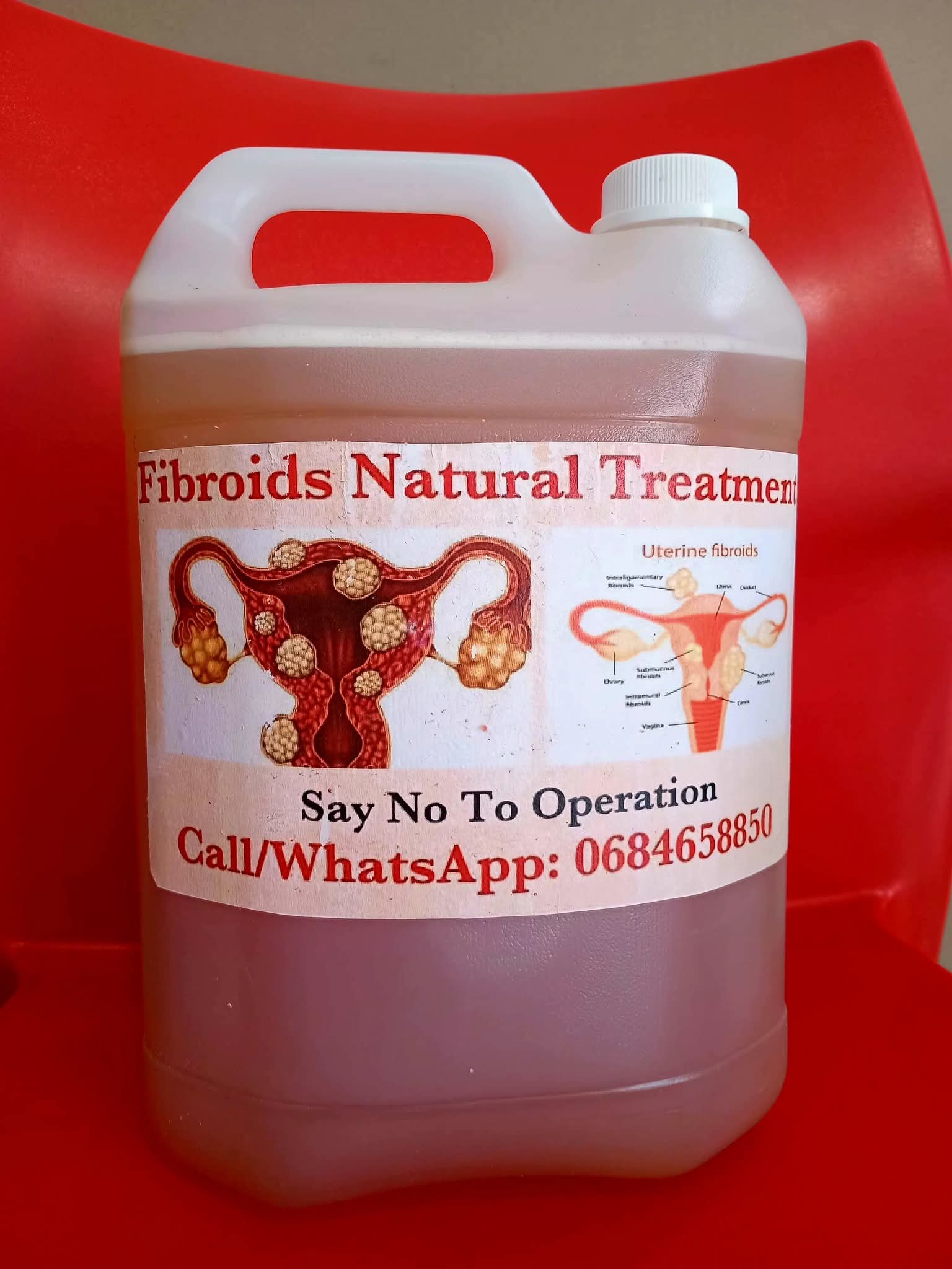 Fibroids are non-cancerous growths in or around the uterus. They can cause heavy bleeding, pelvic pain, bloating, and even fertility issues. Many women don’t even know they have them.