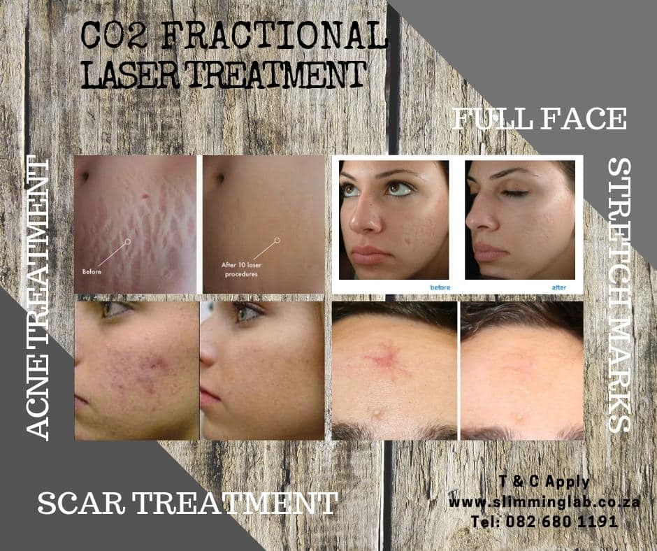 Co2 Fractional laser Treatments 