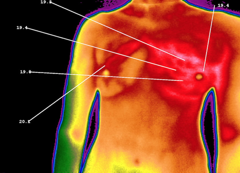 MediTherm - Digital Infrared thermal imaging